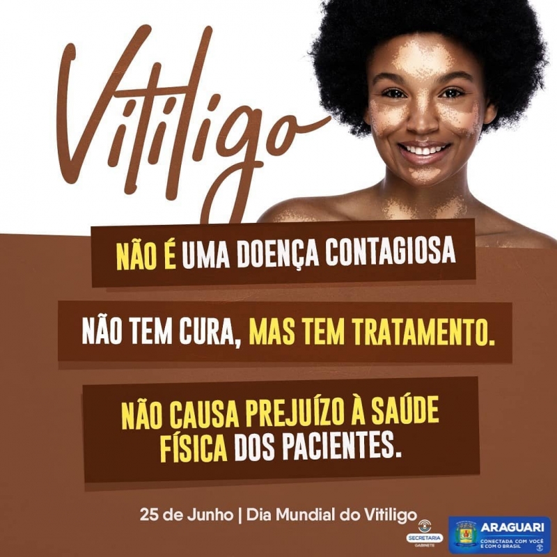 O maior desafio para as pessoas com vitiligo é enfrentar o preconceito. Para tentar combatê-lo e gerar ações de conscientização, criou-se o Dia Mundial do Vitiligo. Aqui no Brasil, a data também está no calendário e todo dia 25 de junho é sempre uma oportunidade para desmistificar as mentiras que rondam quem vive com essa doença genética. O vitiligo, que afeta 1% da população mundial e 0,5% da brasileira, não é contagioso. Apesar de não ter cura, tem tratamento, que deve ser individualizado e acompanhado por um médico dermatologista.