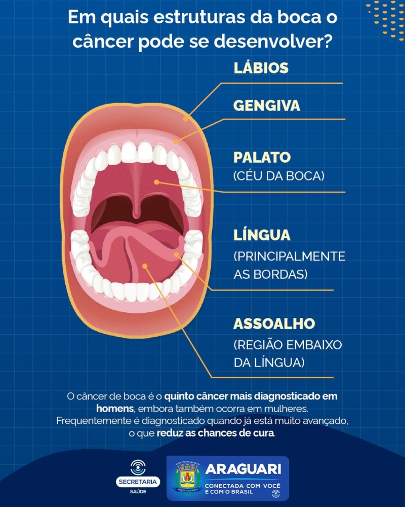 A prefeitura de Araguari, através da secretaria de Saúde está com uma campanha importante que faz um alerta com relação ao Câncer de Boca. E a pergunta principal a ser esclarece é se o câncer de boca tem cura.